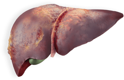 liver-carcinoma